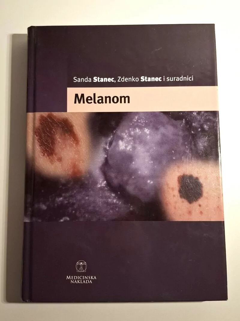 Sanda Stanec , Zdenko Stanec - Melanom (tumori, dermatologija)